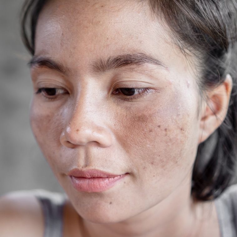 Understanding Hyperpigmentation_ Causes and Solutions